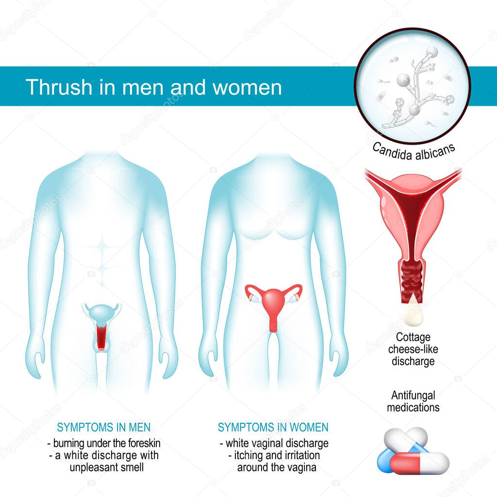 Zorzal En Hombres Y Mujeres Infección Por Levaduras Vulvovaginitis