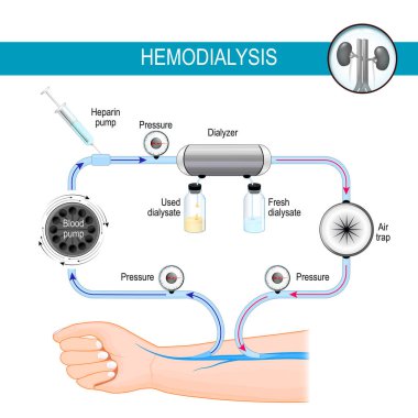 Hemodiyaliz makinesi prensibi. Diyaliz süreci. Hemodiyaliz, kanı, kan damarına geri dönmeden önce filtrelendiği dış bir makineye dönüştürüyor. vektör illüstrasyonu