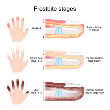 Frostbite stages of fingers. From Frostnip with Loss of feeling in the skin to Deep Frostbite of Joints and muscles. Vector illustration clipart