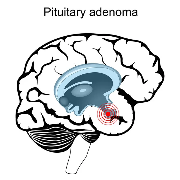 Adénome Hypophysaire Coupe Transversale Cerveau Humain Gros Plan Sur Hypophyse — Image vectorielle