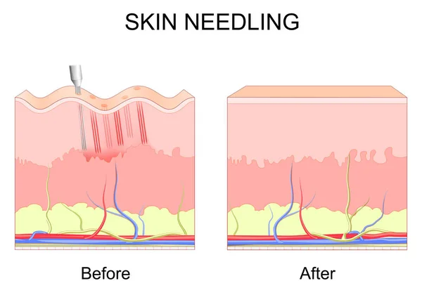 皮肤刺痛 整容前后 有皱纹的人类皮肤的横断面 真皮化过程的特写 胶原诱导疗法 病媒海报 — 图库矢量图片