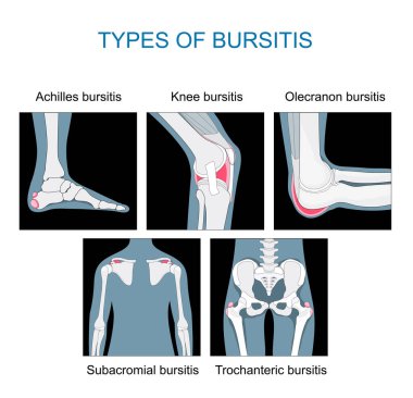 Types of bursitis. inflammation of sacs with synovial fluid. Set icons of Knee, Achilles, hip, elbow and shoulder joints. monochrome flat vector like x-ray illustration. clipart
