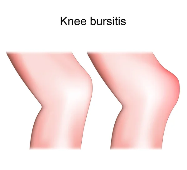 膝関節炎 前立腺炎 関節の健康と炎症の膝の違いと比較 人間の足の側面または側面のビュー ベクターイラスト — ストックベクタ