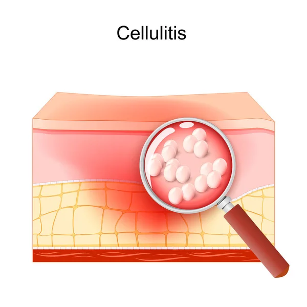 セルリティス 人間の皮膚の層の断面 感染症の症状を伴う脂肪組織 黄色ブドウ球菌の閉鎖 虫眼鏡を通して細菌感染します 皮膚科 ベクターイラスト — ストックベクタ