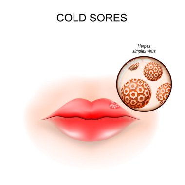 Dudağında soğuk yaralar. Ateş kabarcıkları. Herpes Simplex virüsüne yakın çekim. Vektör illüstrasyonu