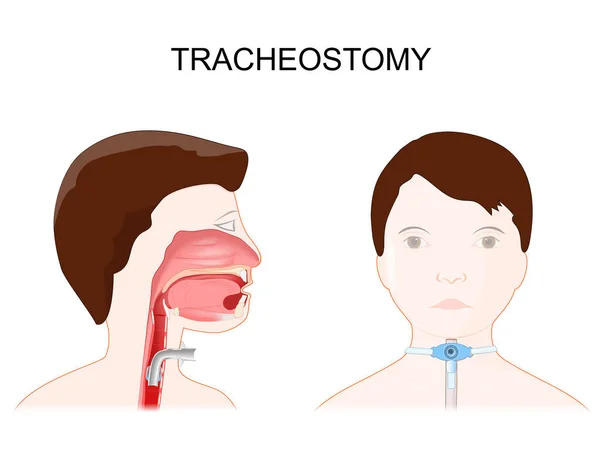 Tracheotomia Vista Laterale Del Collo Posizionamento Tubo Tracheostomico Nella Trachea — Vettoriale Stock