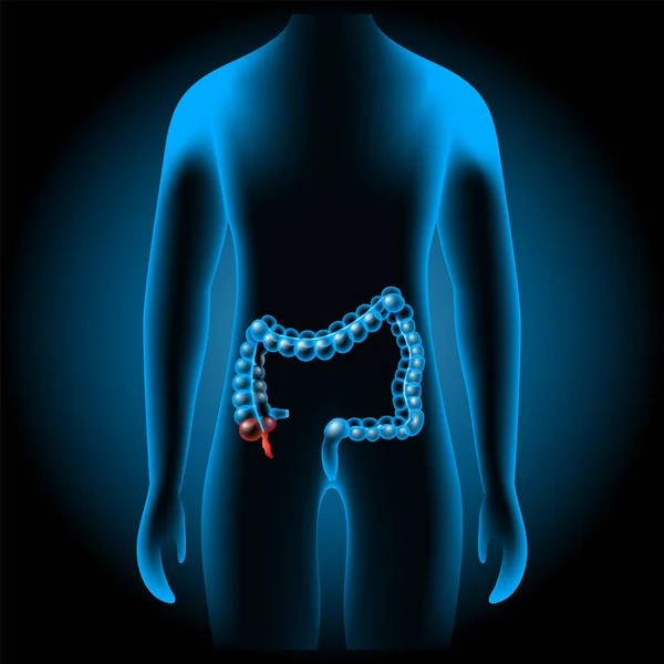 虫垂炎だ 付録の炎症だ 赤の混合物 またはX線青の現実的な胴に直腸の一部 大腸だ 消化管だ 消化器系だ 暗い背景に人間のシルエット 人体解剖学 ベクターポスター — ストックベクタ