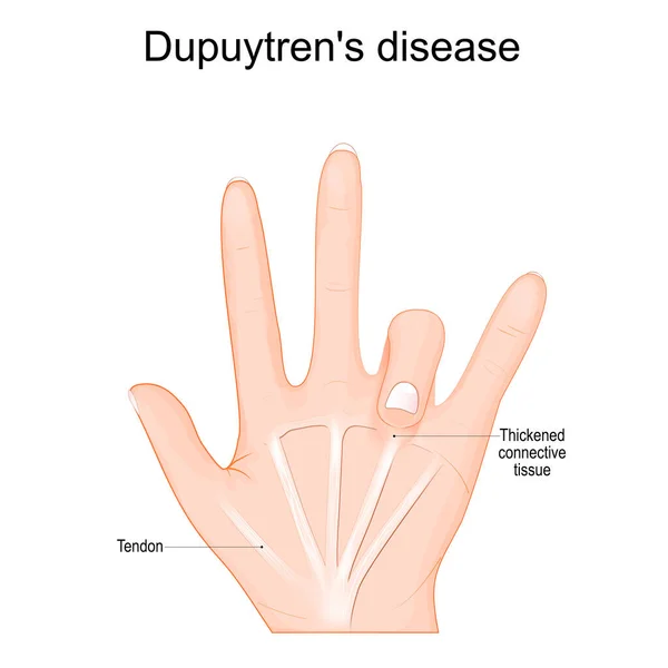 デュピュイトレン病だ 1本の指の下に腱と肥厚結合組織を持つ人間の手 ベクターイラスト — ストックベクタ
