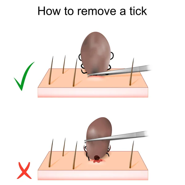 How Remove Tick Mite Removal Vector Illustration — Stock Vector