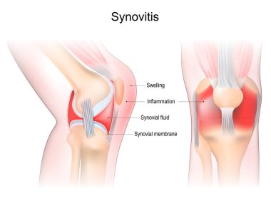 Diz iltihabı. Sinoviyal zarda iltihaplanma olan eklem yakın çekim. Hastalığın belirtileri ve belirtileri. Sinoviyal eklem anatomisi. İnsan diz ekleminin ön ve yan görüntüsü. Vektör illüstrasyonu