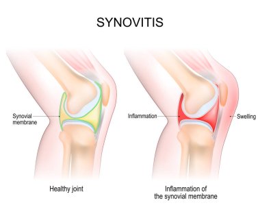 synovitis of a Knee. Close-up of normal joint, and knee with inflammation of the synovial membrane. Signs and symptoms of the disease. side view of human knee joint. Vector illustration clipart