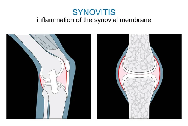 シノビティスの種類 膝関節と滑膜関節の滑膜膜炎 X線図のような単色のフラットベクトル — ストックベクタ