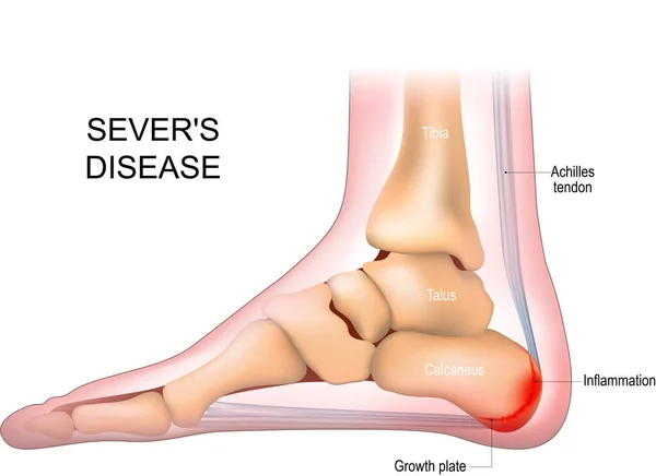 stock vector Severs disease. calcaneus apophysitis. inflammation at the back of the heel growth plate. Foot anatomy. side view of a Human foot with the name of bones. Arches of the feet. skeleton anatomy. realistic Vector poster