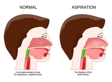 Disfaji ya da aspirasyon. Tıbbi teşhis. İnsan kafasının çapraz kesimi. Nazofarenksi kapatmak için yumuşak bir damak yükseldiğinde epiglotlar kapanır. Sağlıksız insanlar yutkunmakta güçlük çeker ve içerken sıvı solumakta zorlanır.