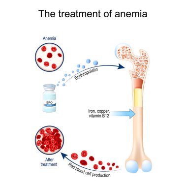 Erythropoietin and treatment of anemia. Glycoprotein cytokine that stimulates red blood cell production. erythropoiesis. Vial with EPO. anemia before and after therapy. Vector illustration