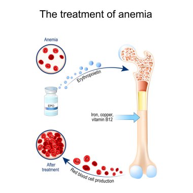 Erythropoietin and treatment of anemia. Glycoprotein cytokine that stimulates red blood cell production. erythropoiesis. Vial with EPO. anemia before and after therapy. Vector illustration clipart