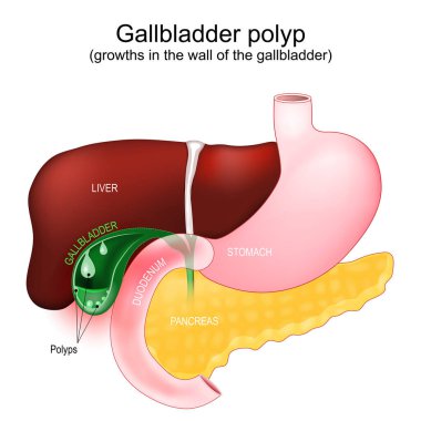 Cross section of a Gallbladder with polyps. Abnormal accumulations of mucous membrane tissue, growths in the wall of the gallbladder. Part of a human gastrointestinal tract with liver, duodenum, pancreas and stomach. Vector poster 