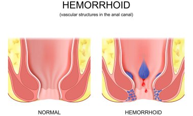 piles. hemorrhoidal disease. comparison and differences between healthy rectum and part of a large intestine with internal and external hemorrhoids, Pectinate line and Rectal bleeding. Cross section of the rectum and anal canal. Vector poster