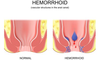 piles. hemorrhoidal disease. comparison and differences between healthy rectum and part of a large intestine with internal and external hemorrhoids, Pectinate line and Rectal bleeding. Cross section of the rectum and anal canal. Vector poster clipart