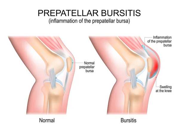 Prepatellar Bursitis Inflammation Prepatellar Bursa Comparison Human Knee Normal Prepatellar — Διανυσματικό Αρχείο