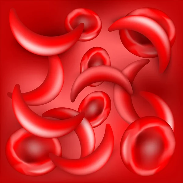 Хвороба Серповидноклітинної Системи Скд Нормальні Еритроцити Серповидноклітини Кровопостачанні Червоний Фон — стоковий вектор