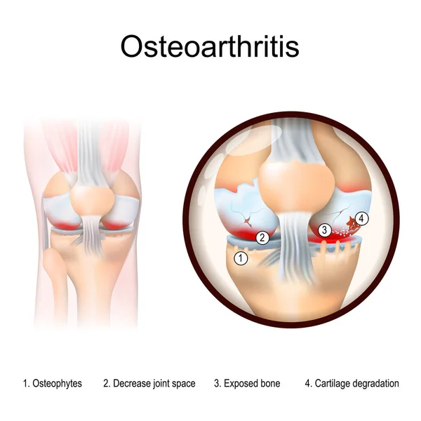 変形性関節症 膝の炎症を持つ人間の足 関節炎の症状と膝関節の閉鎖 軟骨の劣化 骨露出 関節スペースを減少させます と変形性関節症 ベクターイラスト — ストックベクタ