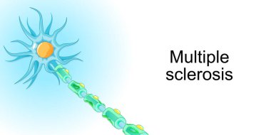 Çoklu skleroz. Demiyelinating hastalığı. Otoimmün hastalık. Dünya Çoklu Skleroz Günü hakkında poster veya afiş için vektör illüstrasyonu. 