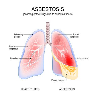asbestosis lungs. Inflammation and scarring of the lungs due to asbestos fibers. cancer. Vector illustration clipart