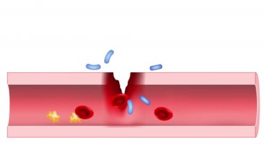 Kan zehirlenmesi. Bakteriyel enfeksiyonlu kan damarının enine kesiti. Septisemi ölümcül bir hastalıktır. Sepsis etkileri.