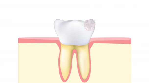 歯痛だ 臼歯や前臼歯の痛み 敏感な歯のエナメル質の脈動の2Dアニメーション — ストック動画