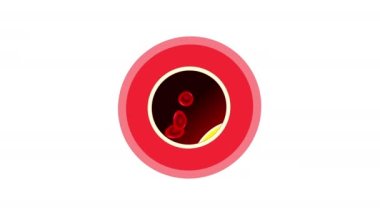 Ateroskleroz aşamaları. Atardamarda kolesterol. Yağ çizgisinden kireçlenme ve tromboza kadar plağın gelişimi. Kardiyovasküler hastalık. İnsan anatomisi. sağlık riski