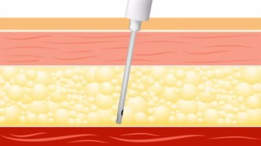Liposuction prosedürü. Önce ve sonra. şişman modelleme ve ameliyat