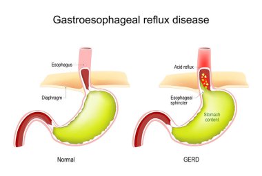 Gastroözofagus reflü hastalığı. GERD. İnsan midesinde enine kesit. Asit reflü ile normal iç organ ve mide. Vektör illüstrasyonu
