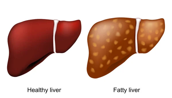 脂肪肝疾患 健康な肝臓と肝性脂肪症 過剰脂肪が肝臓に蓄積する状態です ベクターイラスト — ストックベクタ