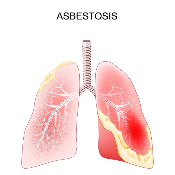 Asbestosis 因接触石棉纤维而引起的肺病 有纤维化和疤痕的人肺横断面的特写 矢量说明 — 图库矢量图片