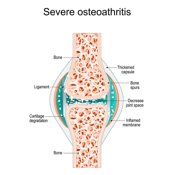 Artrosi Grave Articolazione Sinoviale Con Speroni Ossei Membrana Infiammata Riduzione — Vettoriale Stock