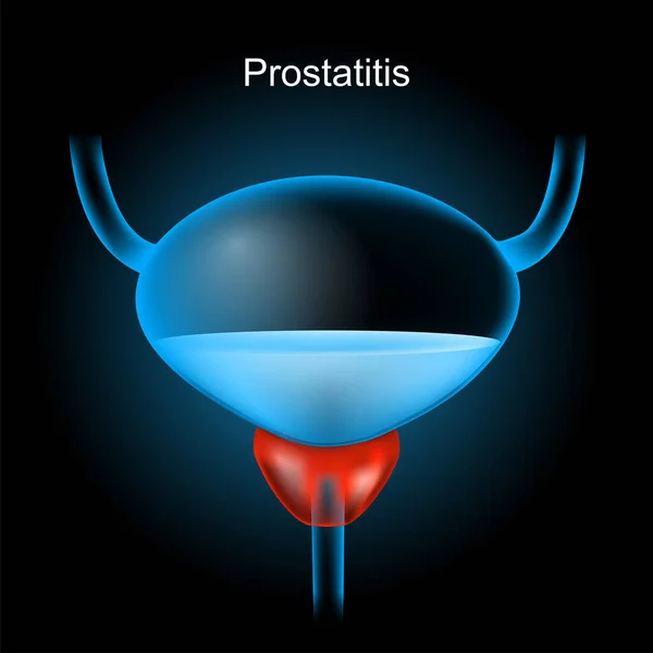 前列腺炎 红色的前列腺和蓝色的现实膀胱 在黑暗的背景下发光效果 人类的泌尿系统男性生殖系统的一部分 矢量插图 如X射线图像 — 图库矢量图片