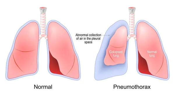 Neumotórax Acumulación Aire Entre Pulmón Cavidad Torácica Pulmones Normales Colapsados — Vector de stock