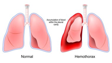 Hemothorax. Healthy human lungs and red lungs after accumulation of blood within the pleural cavity. Chest trauma. pulmonary embolism treatment. Vector poster clipart