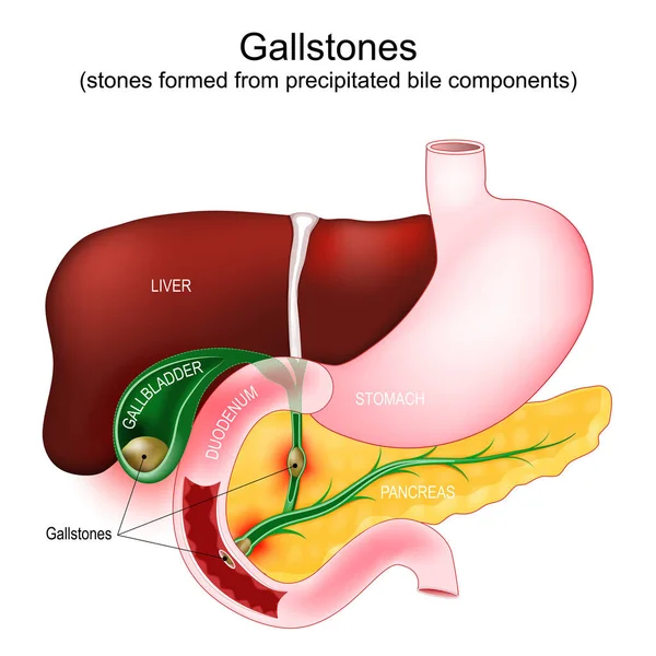 stock vector Gallstones. cholecystolithiasis when stone in the gallbladder, choledocholithiasis - gallstone blocks a bile duct. Parts of a digestive system: gallbladder, duodenum, stomach, liver, and pancreas. human anatomy. Vector poster 