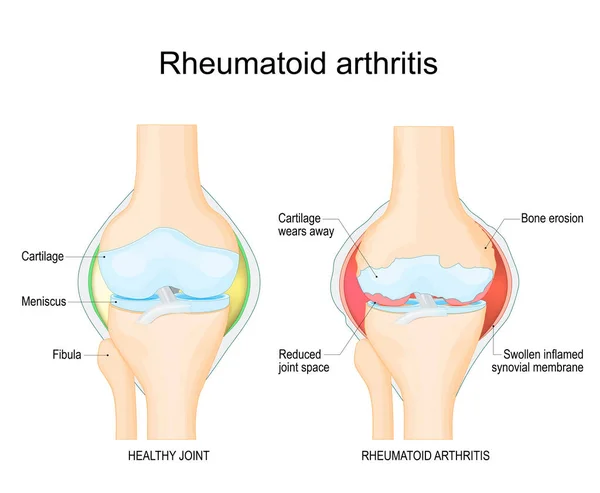 Rheumatoid Arthritis Comparison Healthy Knee Joint Bone Erosion Cartilage Wears — Stock Vector