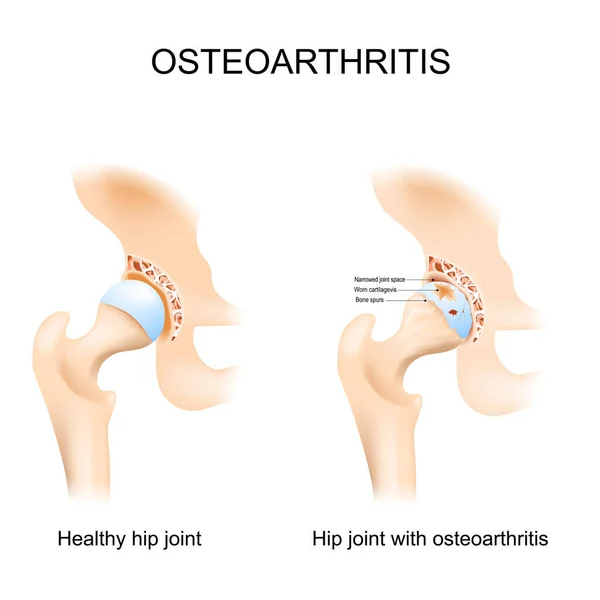 Articulação Quadril Com Osteoartrite Com Cabeça Femoral Acetábulo Pelve Uma — Vetor de Stock