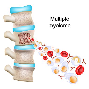 Çoklu miyelom. Omurganın kemik yapısı ve kemik iliğine sahip enine kesitli bir omur parçası. Anormal plazma hücrelerine, kırmızı kan hücrelerine ve antikorlara yakın çekim. Vektör illüstrasyonu