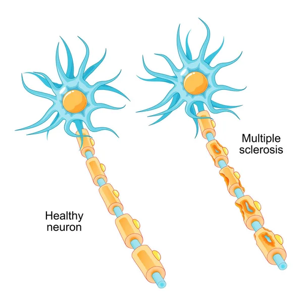 多発性硬化症 自己免疫疾患 健康なニューロンと損傷したミエリン鞘を持つニューロンの比較です 免疫系によって損傷を受けたMs神経 ベクターイラスト — ストックベクタ