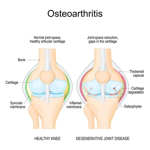 変形性関節症 健康な膝が結合し 関節炎 変性関節疾患 ベクターイラスト — ストックベクタ