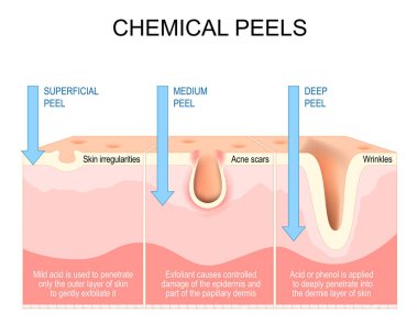 Chemical peels. Exfoliation. rejuvenation of face for Wrinkles, and Acne scars. Treatment of skin irregularities, hyperpigmentation. Cross section of a human skin. Vector illustration clipart