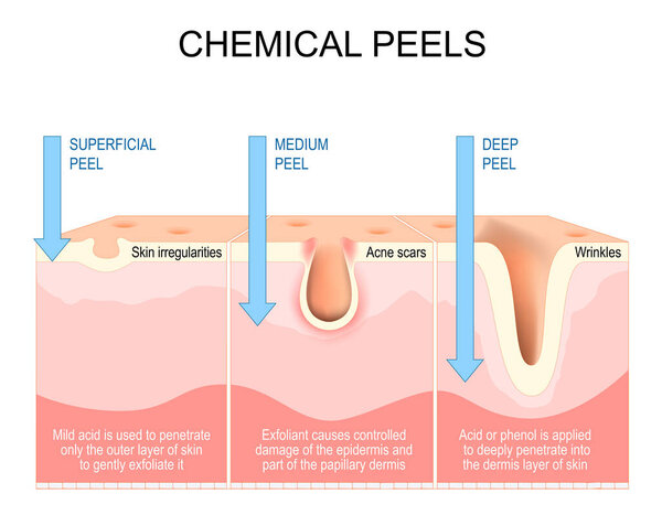Chemical peels. Exfoliation. rejuvenation of face for Wrinkles, and Acne scars. Treatment of skin irregularities, hyperpigmentation. Cross section of a human skin. Vector illustration