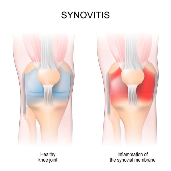 シノビティス 膝関節の解剖学 健康な関節 滑膜膜の炎症 正面の眺め 前の側面 ベクターイラスト — ストックベクタ
