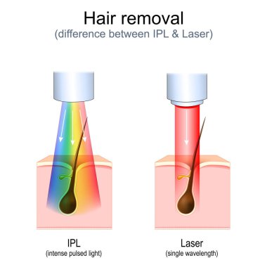Saç kesimi. Lazer ve Yoğun Pulsed Light (IPL). Tedavi sırasında deri ve saç durumuyla ilgili vektör diyagramı. Estetik cerrahi. Güzellik reklamları. Gerçekçi çizim