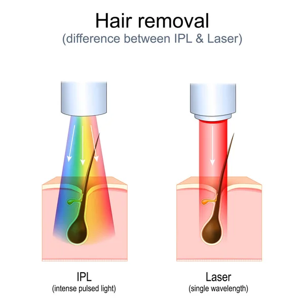 レーザー対激しいパルス光 Ipl 治療セッション中の皮膚や髪の状態についてのベクトル図 化粧品外科 美容広告 写実的なイラスト — ストックベクタ
